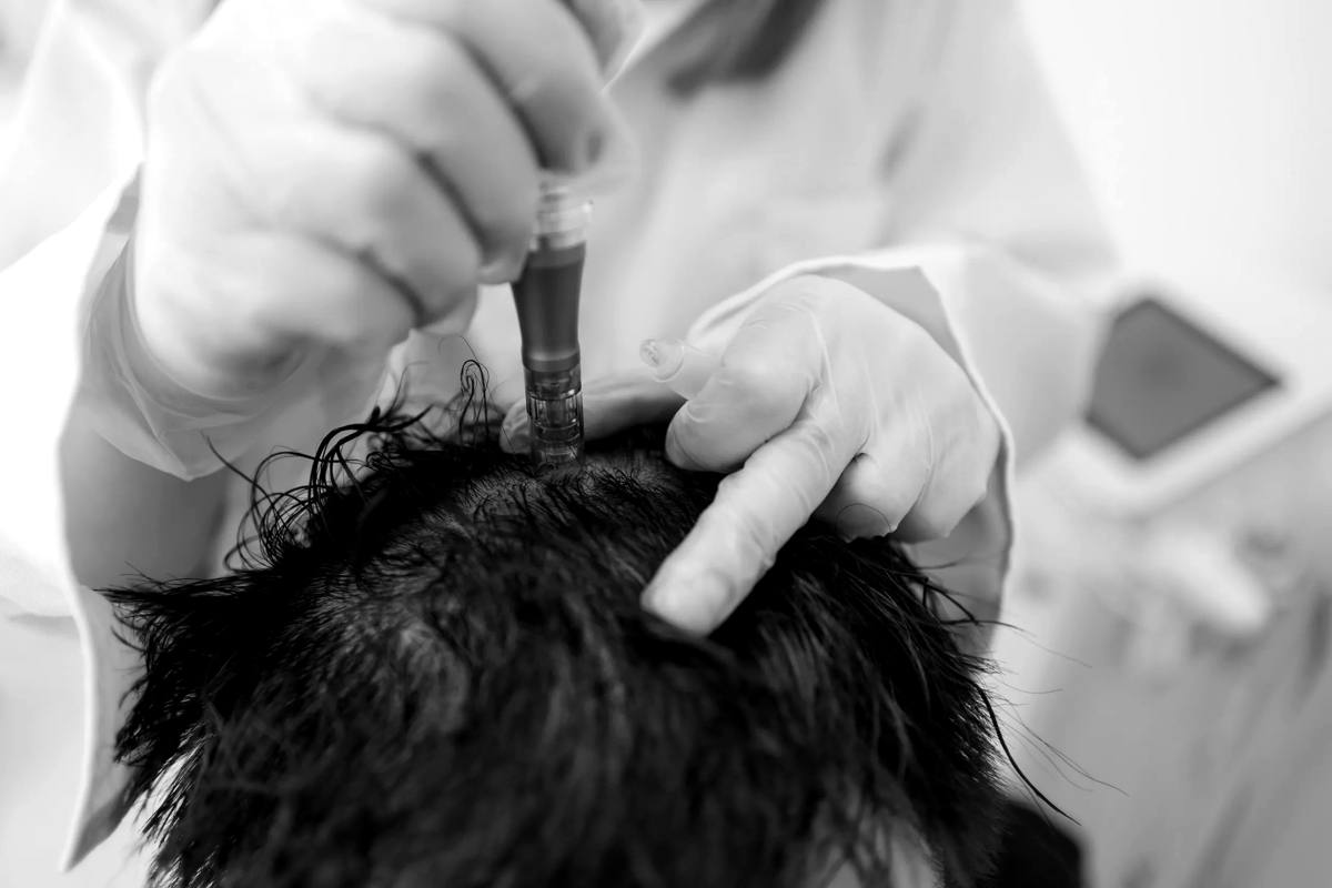 Tratamiento médico del cuero cabelludo con dermapen